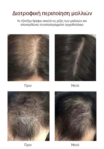 Oveallgo™ | Ενισχύστε την ανάπτυξη των μαλλιών σας φυσικά (1+1 ΔΩΡΕΑΝ)